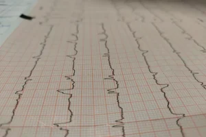 أمراض القلب: تخطيط القلب
